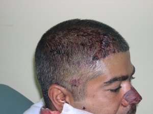 Spec. Monciglio in the Combat Surgical Hospital with Head, nose & Neck Wounds