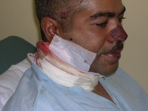 Spec. Monciglio's Wounds from I.E.D shrapnel 